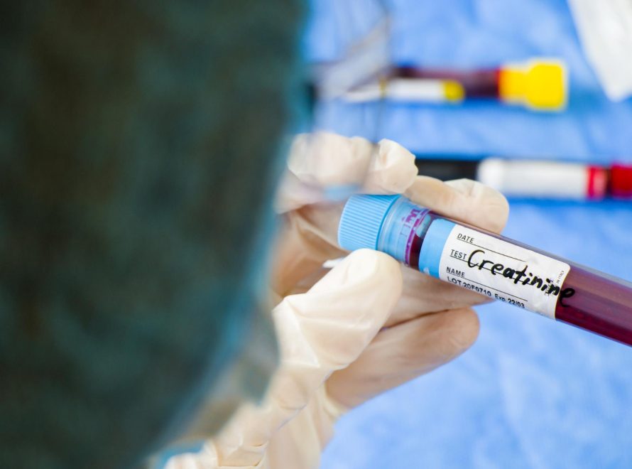 azotemia e creatinina alta