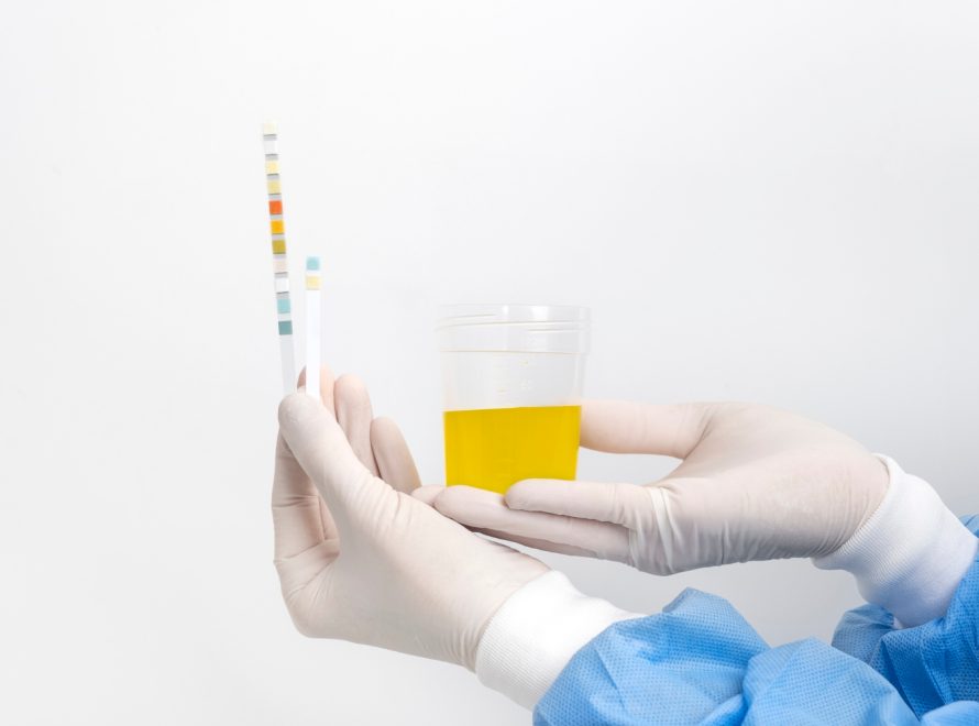 albumina nelle urine