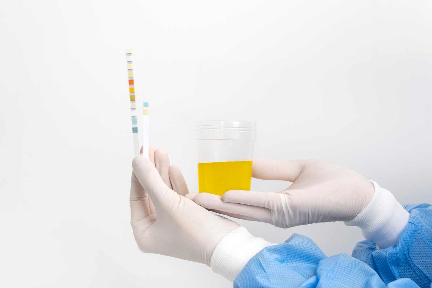 albumina nelle urine